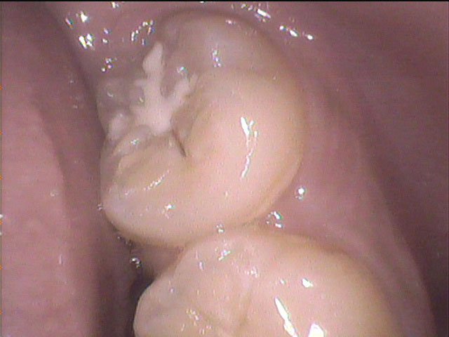 シーラント悪化1のイメージ
