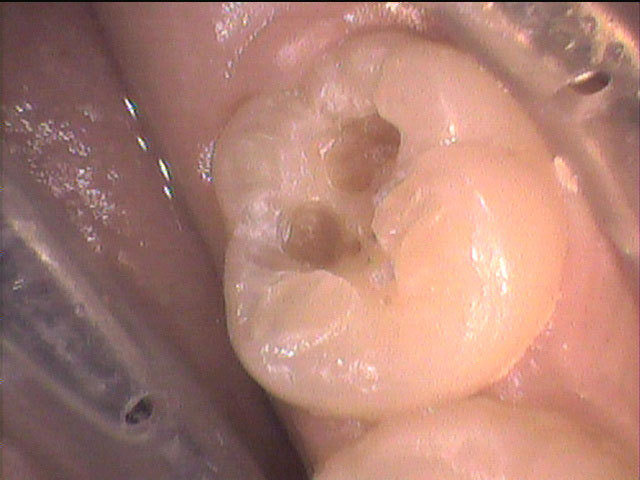 シーラント悪化2のイメージ