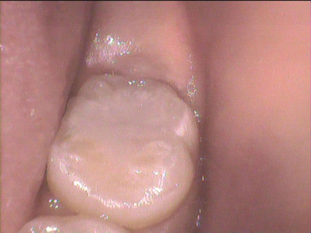 シーラント悪化4のイメージ