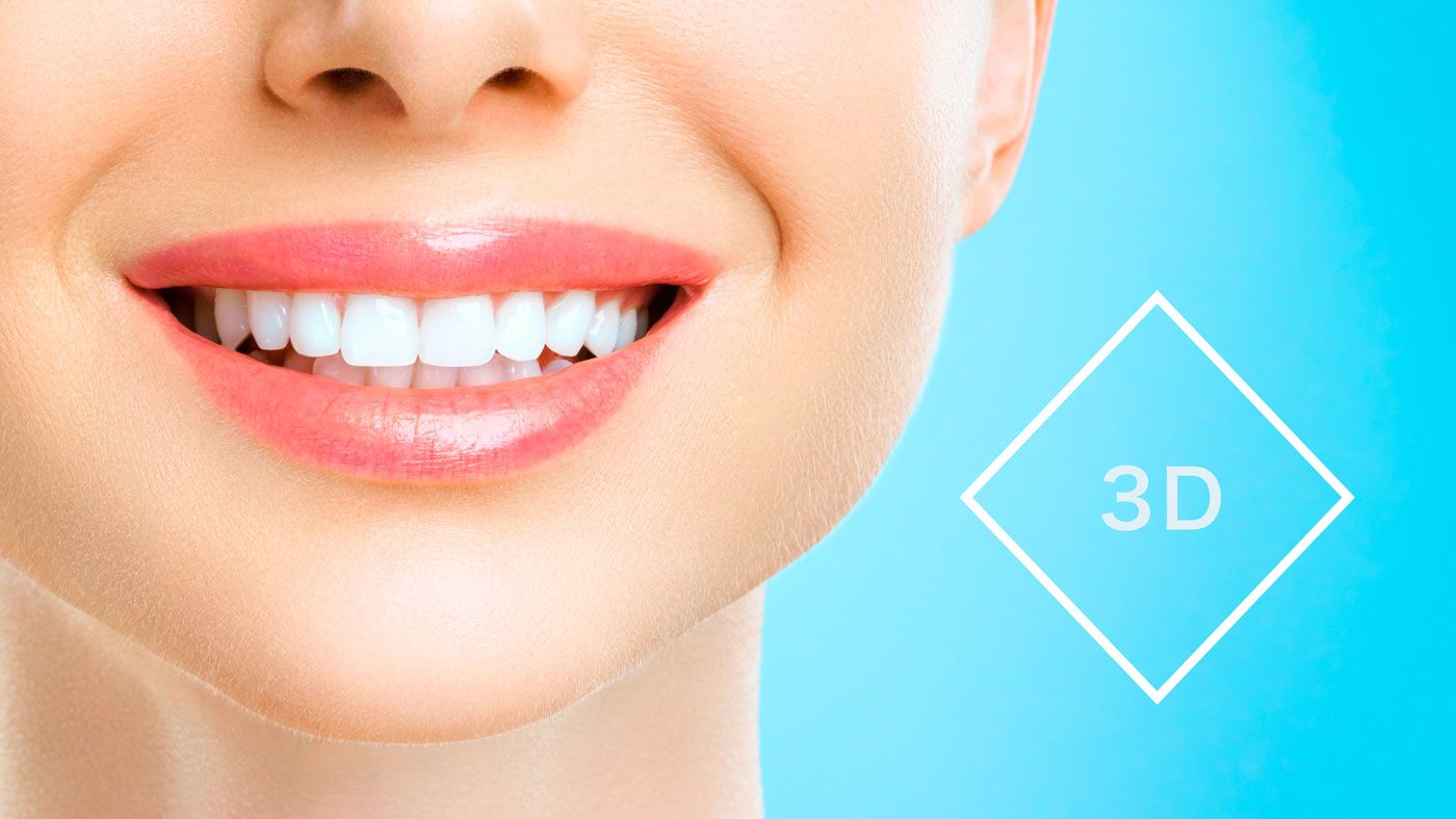 3Dカスタム矯正のイメージ