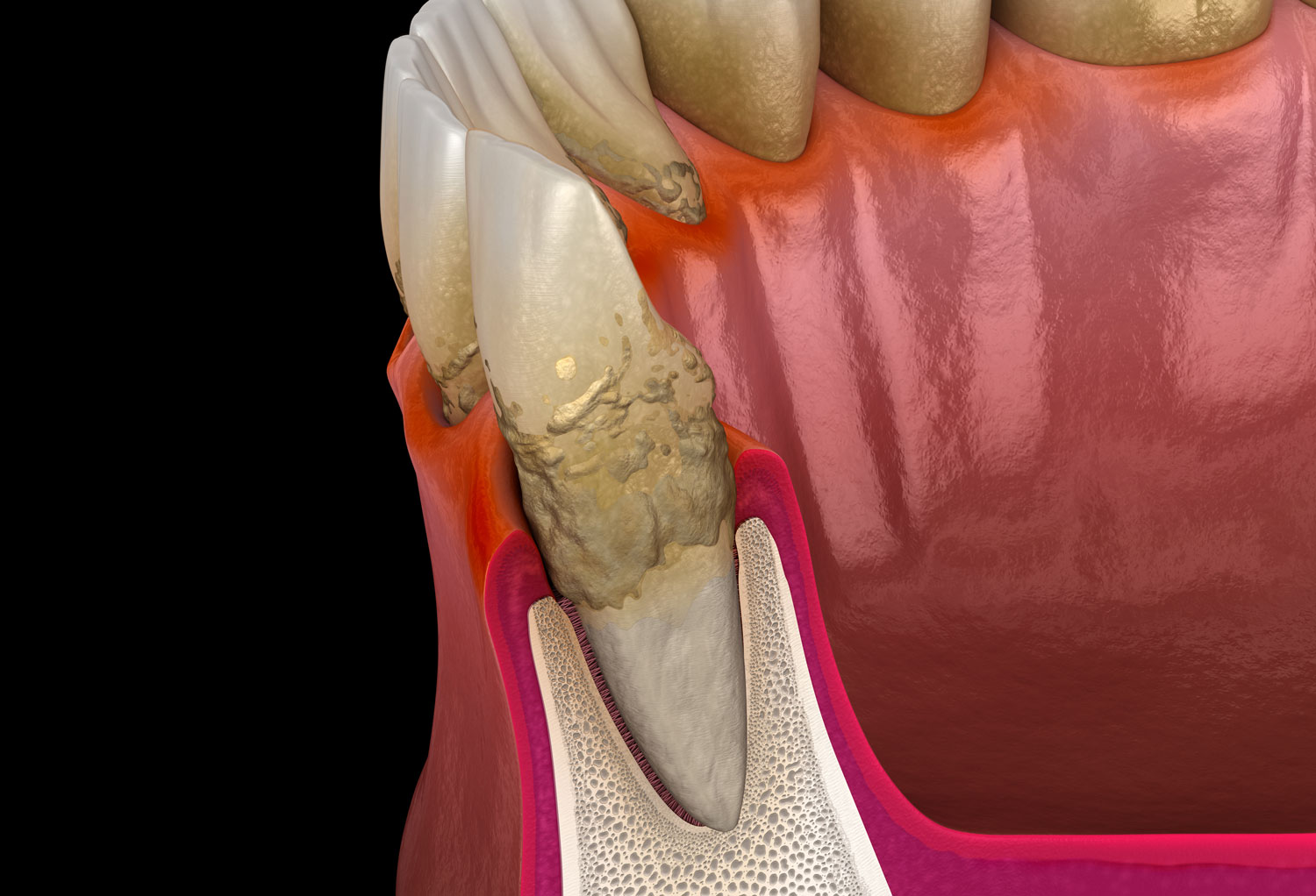 歯周病が進行した状態の画像